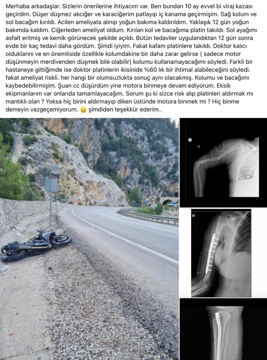 Viraj Kazası Geçirdi, Motosikletten Vazgeçmedi